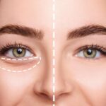 Under eye dermal fillers in Mumbai at Magniva Aesthetics